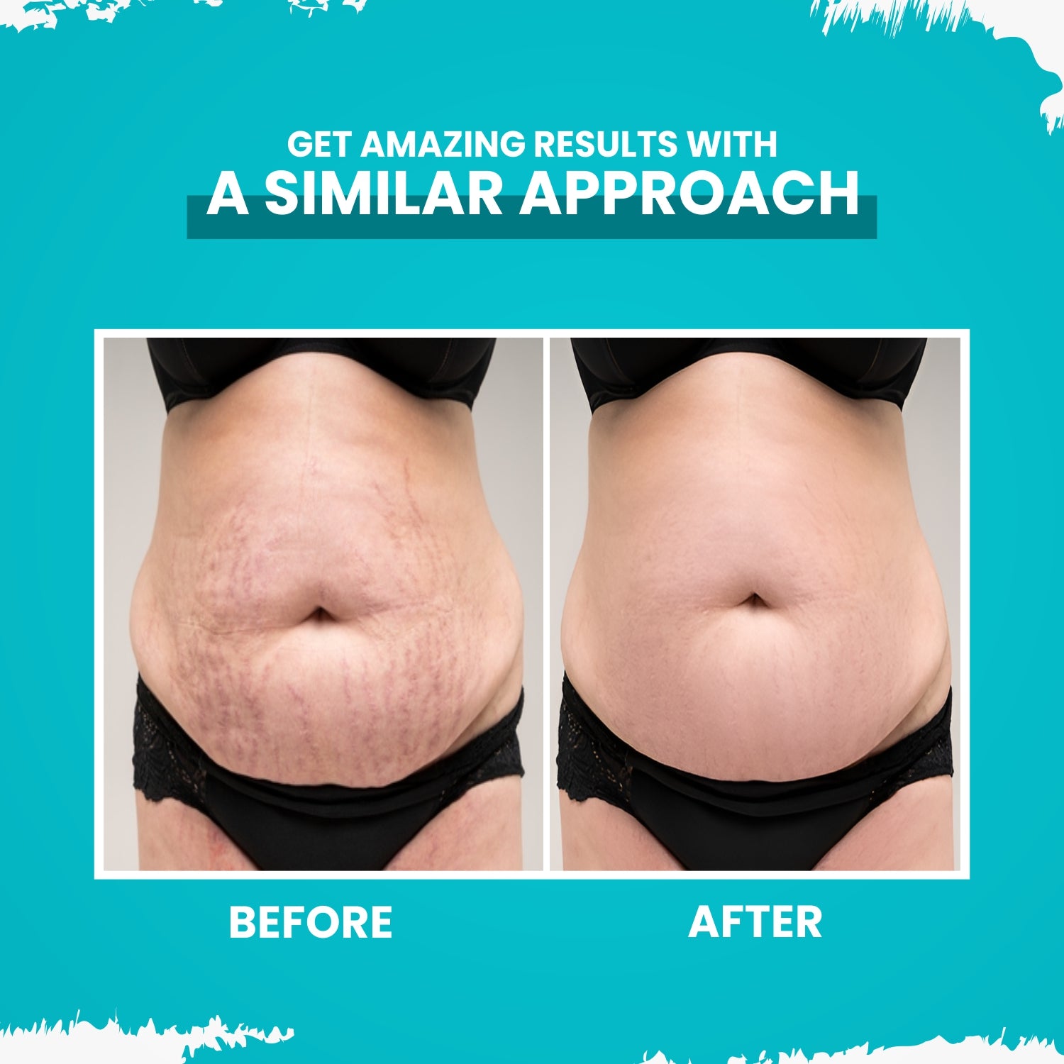 Flawless Skin Ahead: Stretch Mark Removal Cream for All Skin Types (50g)